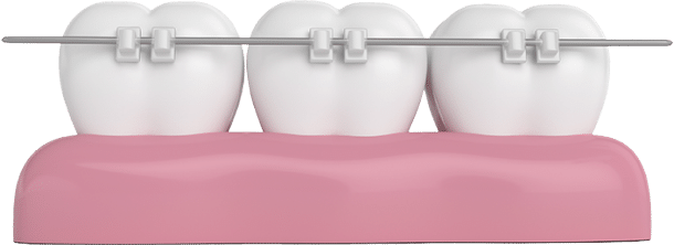 Clear Braces