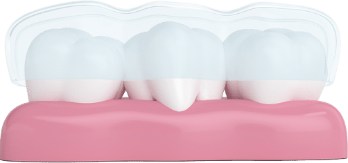 Invisalign