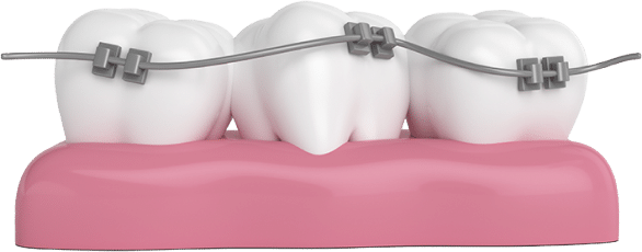 Metal Braces